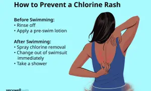 Illustration showing a person scratching a red rash on their back, likely an allergic reaction to chlorine. Tips for prevention are listed.