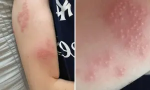 Red, blistered rash on an arm, likely shingles. This image prompts the question: can you swim with shingles?