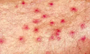 Close-up of skin with numerous small red bumps, possibly indicating an infection. Research suggests chlorine can help kill staph infection.