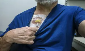 A man lifts his blue shirt to reveal a medical port on his chest. He's wondering, "Can you swim with a port?