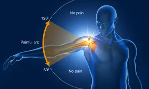 An anatomical illustration showing the painful arc of swimmer's shoulder, with pain occurring between 60° and 120° of arm abduction.