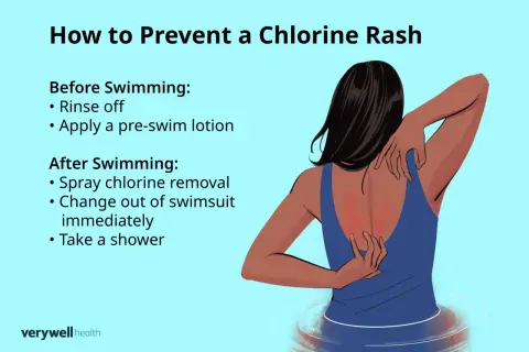 Illustration showing a person scratching a red rash on their back, likely an allergic reaction to chlorine. Tips for prevention are listed.