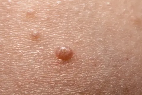 Close-up of skin with molluscum contagiosum lesions. The question of whether chlorine kills molluscum contagiosum is a common concern for those affected.