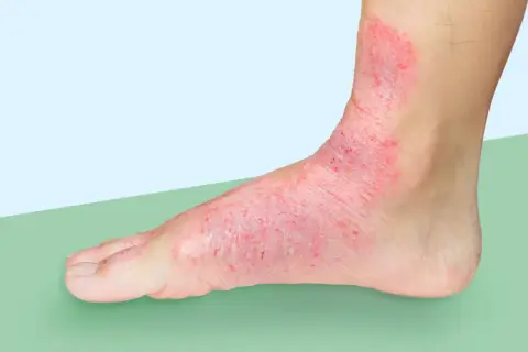 Red, inflamed skin covers the top of a foot and ankle, extending to the big toe. This condition, often called swimmer's toe, looks painful.