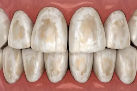 Close-up of stained teeth, showing discolored enamel with brown and white patches, reminiscent of swimmers teeth.