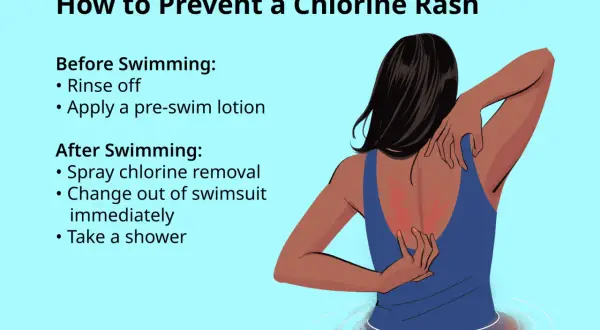 Illustration showing a person scratching a red rash on their back, likely an allergic reaction to chlorine. Tips for prevention are listed.