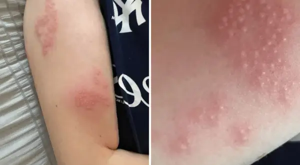 Red, blistered rash on an arm, likely shingles. This image prompts the question: can you swim with shingles?