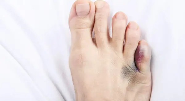 A bruised and swollen toe, likely from a broken toe, rests on white fabric. Wondering if you can swim with a broken toe?