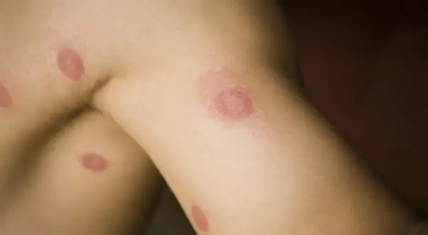 Red, circular lesions on skin. This image shows ringworm, a fungal infection. It's best to avoid swimming with ringworm until treated.