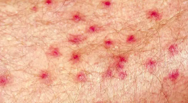 Close-up of skin with numerous small red bumps, possibly indicating an infection. Research suggests chlorine can help kill staph infection.