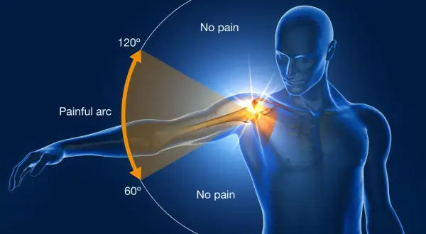 An anatomical illustration showing the painful arc of swimmer's shoulder, with pain occurring between 60° and 120° of arm abduction.