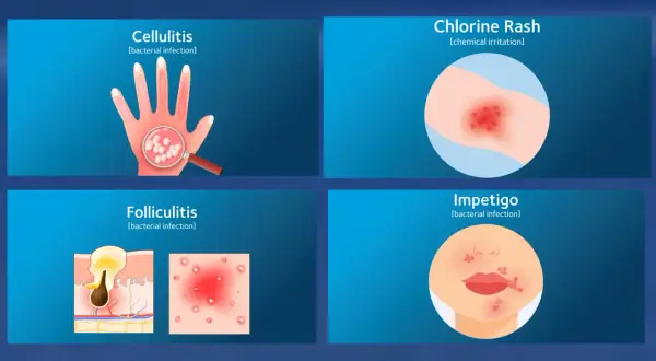 Illustrations show skin conditions: Cellulitis on a hand, Chlorine Rash on an arm, Folliculitis in skin layers, and Impetigo on a face. Can you swim with impetigo? No.