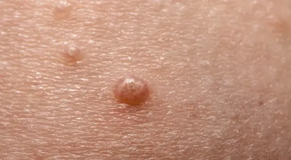 Close-up of skin with molluscum contagiosum lesions. The question of whether chlorine kills molluscum contagiosum is a common concern for those affected.