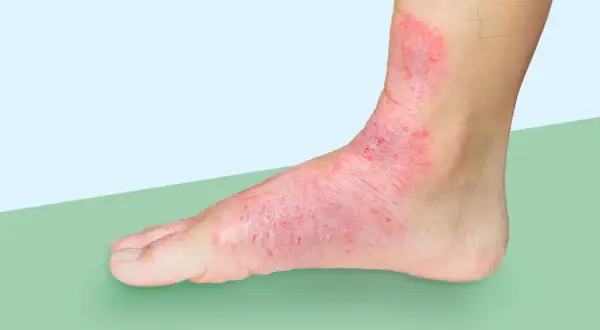 Red, inflamed skin covers the top of a foot and ankle, extending to the big toe. This condition, often called swimmer's toe, looks painful.
