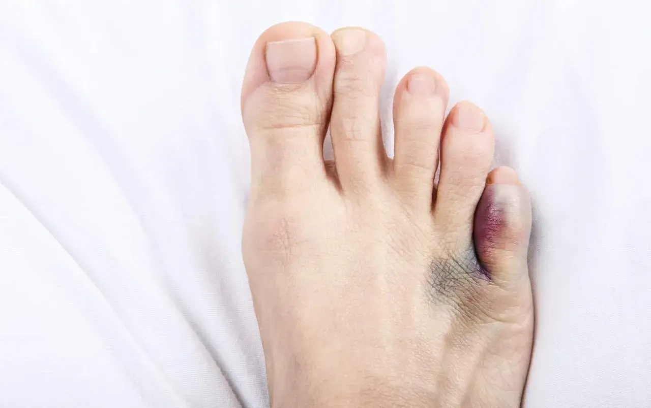 A bruised and swollen toe, likely from a broken toe, rests on white fabric. Wondering if you can swim with a broken toe?
