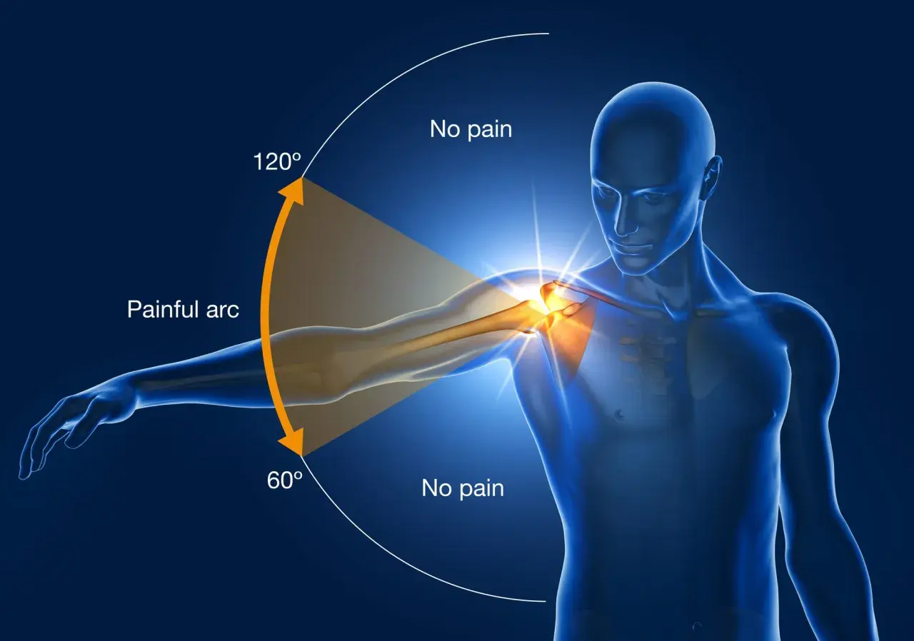An anatomical illustration showing the painful arc of swimmer's shoulder, with pain occurring between 60° and 120° of arm abduction.