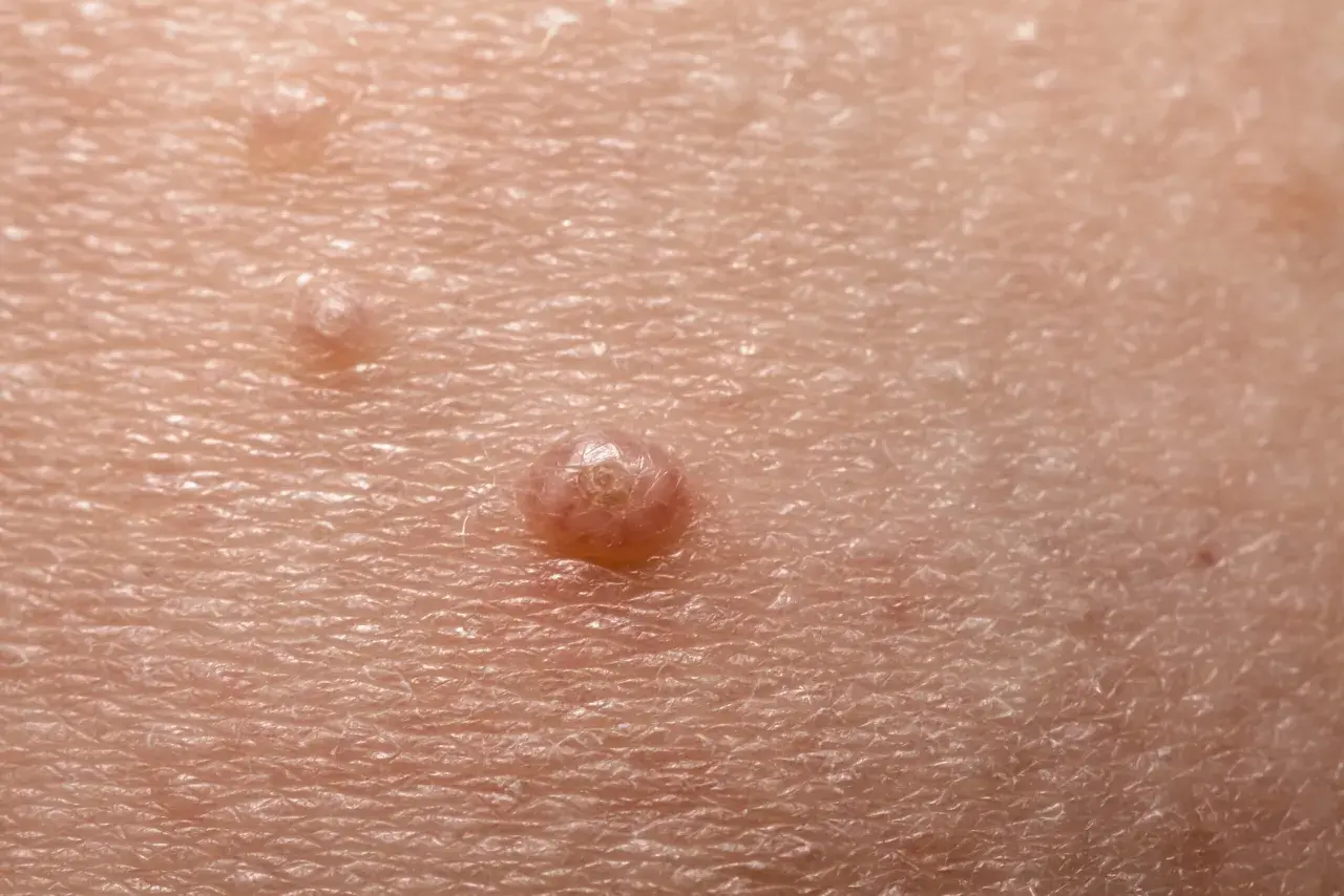 Close-up of skin with molluscum contagiosum lesions. The question of whether chlorine kills molluscum contagiosum is a common concern for those affected.