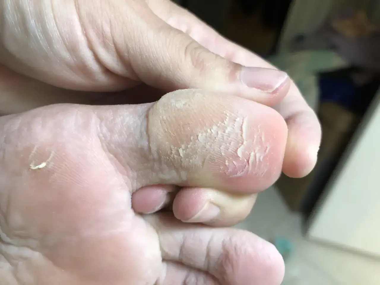 Close-up of a foot showing dry, flaky skin on the big toe, possibly from a swimmer's toe condition.