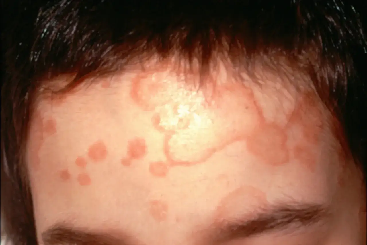 Red, ring-shaped rashes on a person's forehead. This image raises the question: can you swim with ringworm?