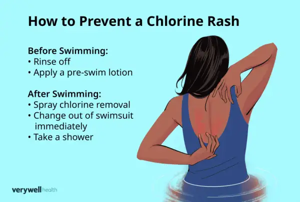 Illustration showing a person scratching a red rash on their back, likely an allergic reaction to chlorine. Tips for prevention are listed.