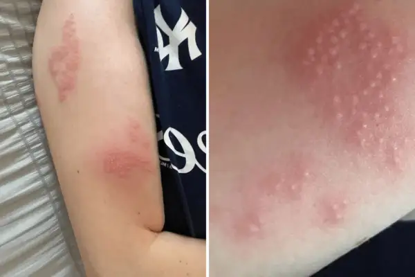 Red, blistered rash on an arm, likely shingles. This image prompts the question: can you swim with shingles?
