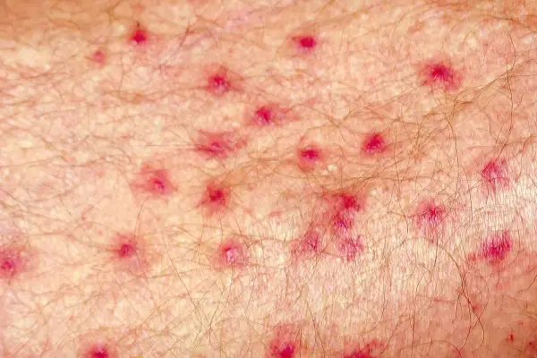 Close-up of skin with numerous small red bumps, possibly indicating an infection. Research suggests chlorine can help kill staph infection.