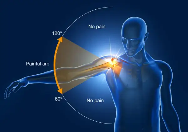 An anatomical illustration showing the painful arc of swimmer's shoulder, with pain occurring between 60° and 120° of arm abduction.