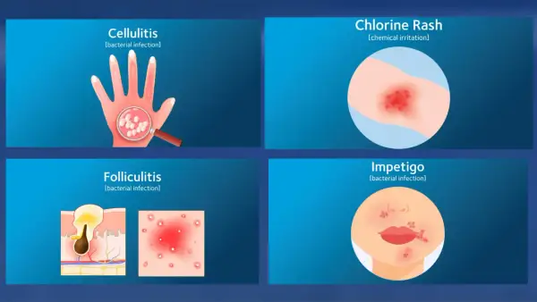 Illustrations show skin conditions: Cellulitis on a hand, Chlorine Rash on an arm, Folliculitis in skin layers, and Impetigo on a face. Can you swim with impetigo? No.