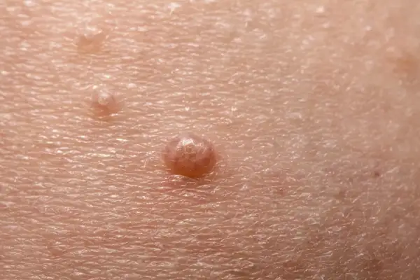 Close-up of skin with molluscum contagiosum lesions. The question of whether chlorine kills molluscum contagiosum is a common concern for those affected.