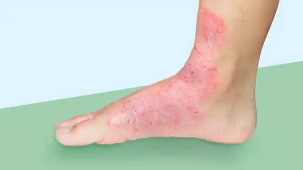 Red, inflamed skin covers the top of a foot and ankle, extending to the big toe. This condition, often called swimmer's toe, looks painful.